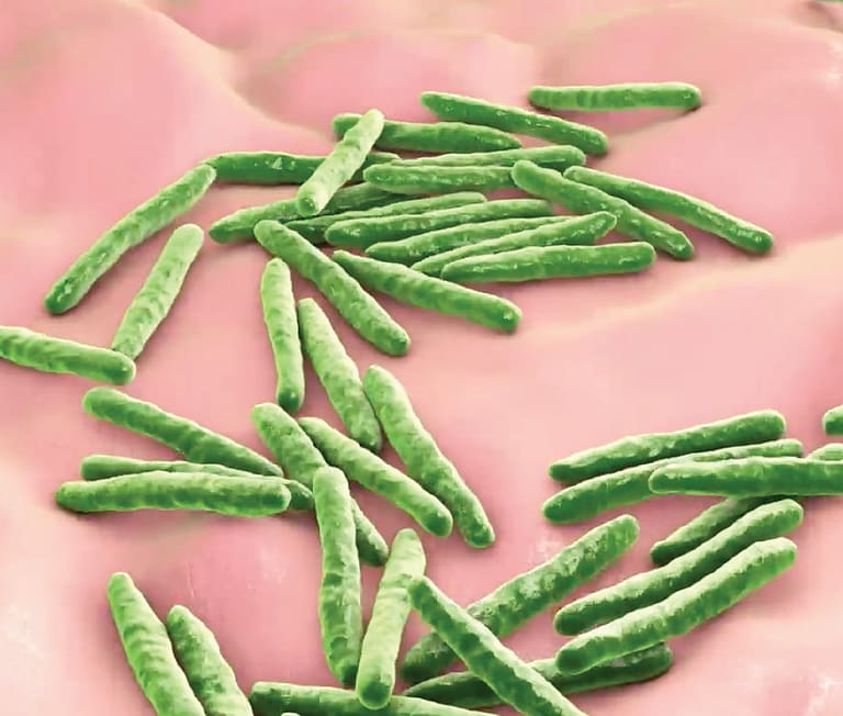 Tuberculosis Meningitis in an Immunocompetent Patient